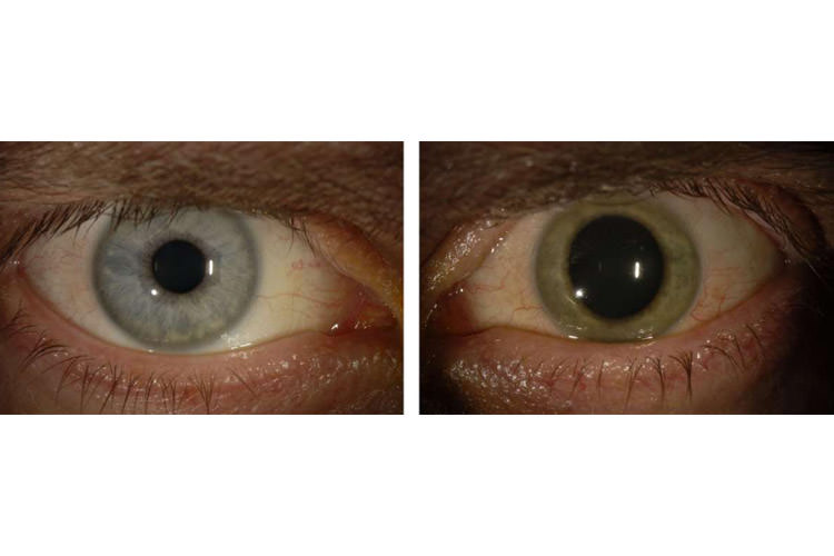 ابولا رنگ چشم یک پزشک مبتلا را تغییر داد