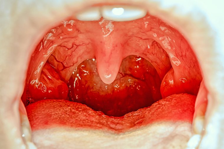 زبان کوچک / Uvula