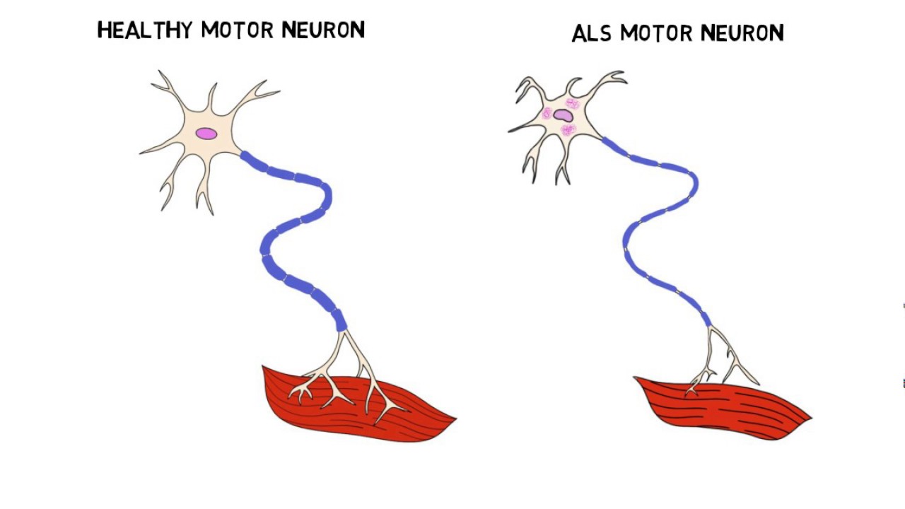 بیماری ALS /  ALS 