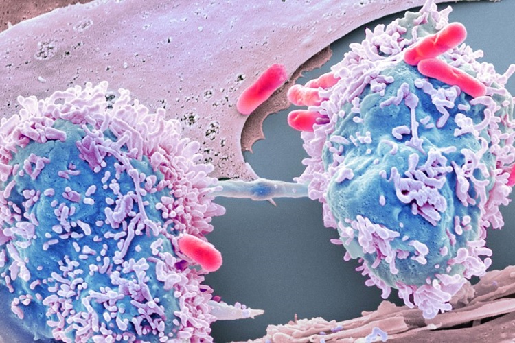 استفاده از روش کریسپر برای حذف سلول های سرطانی 