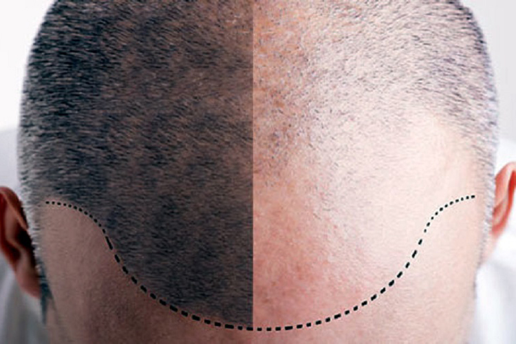 امیدواری دانشمندان برای درمان سفیدی و ریزش مو