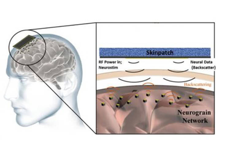 neuro implant