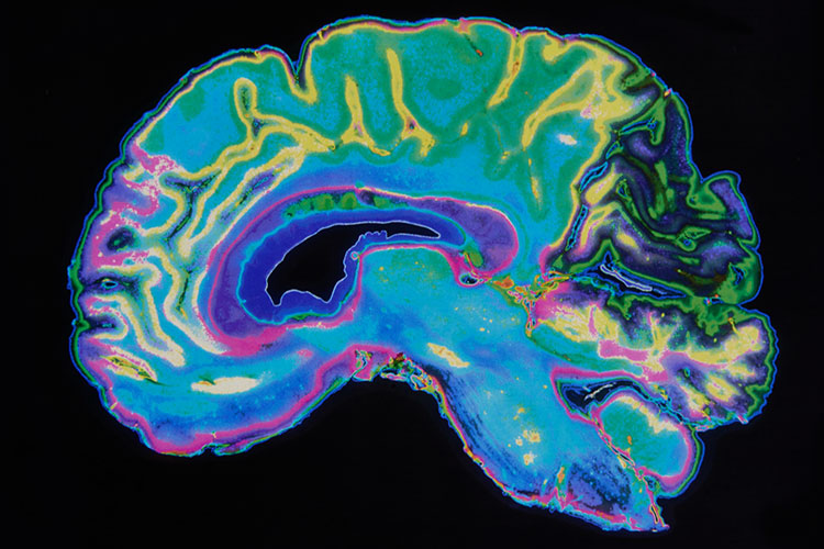 تشخیص بیماری اسکیزوفرنی از جریان خون مغز توسط هوش مصنوعی آی بی ام