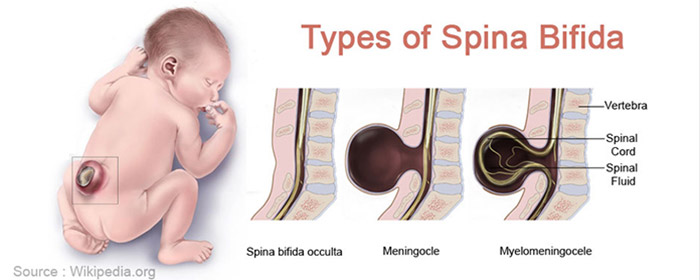 اسپینا بیفیدا/spina bifida