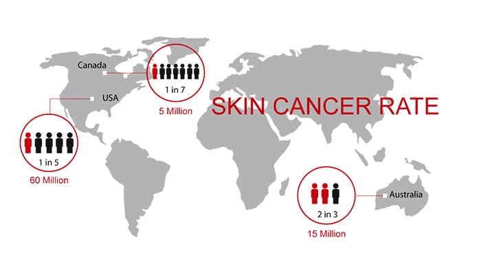 شیوع سرطان پوست در دنیا