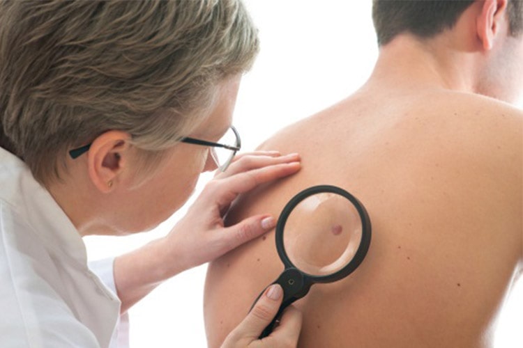 سرطان پوست: علایم، پیشگیری و درمان