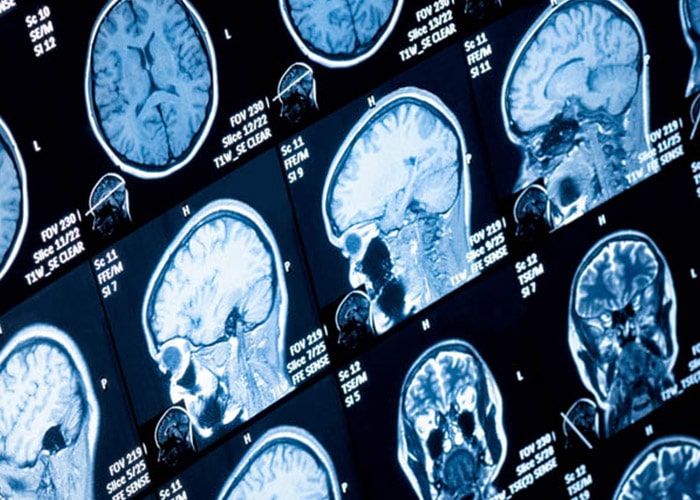 تشخیص پارکینسون بر اساس اسکن مغز