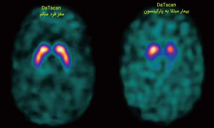 مقایسه مغز بیمار پارکینسونی با مغز سالم 