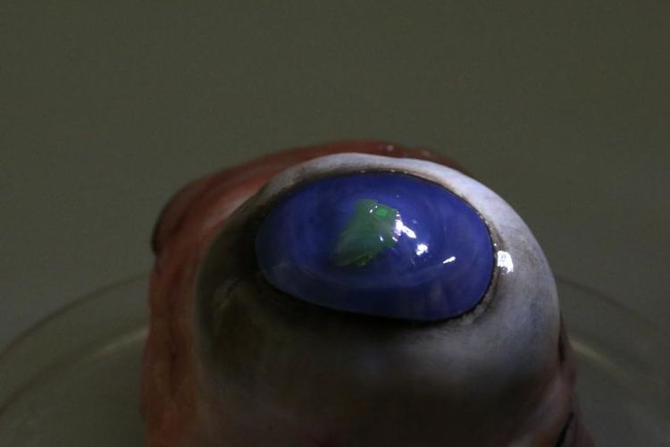 لنز چشمی با توانایی تساطع اشعه لیزر از چشم