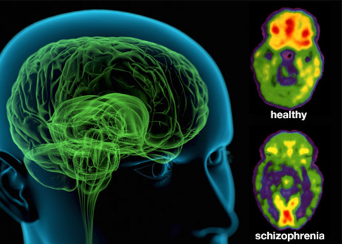 مغز اسکیزوفرنی در مقایسه با مغز سالم