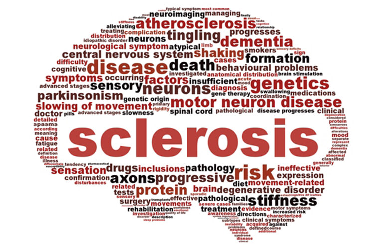 بیماری ام اس چیست و چه درمان‌هایی دارد؟