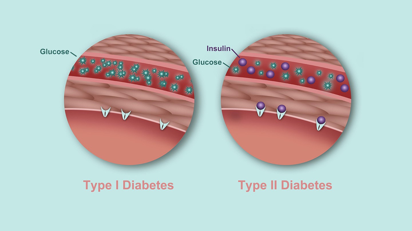دیابت نوع دو / type 2 diabetes