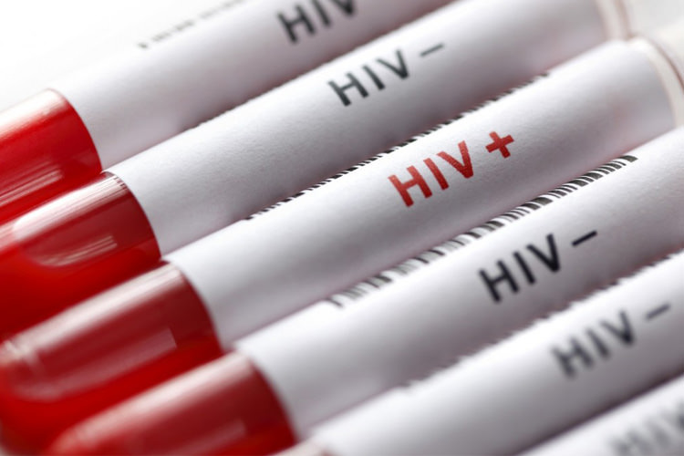 ایدز و HIV، علایم، انتقال، درمان و پیشگیری