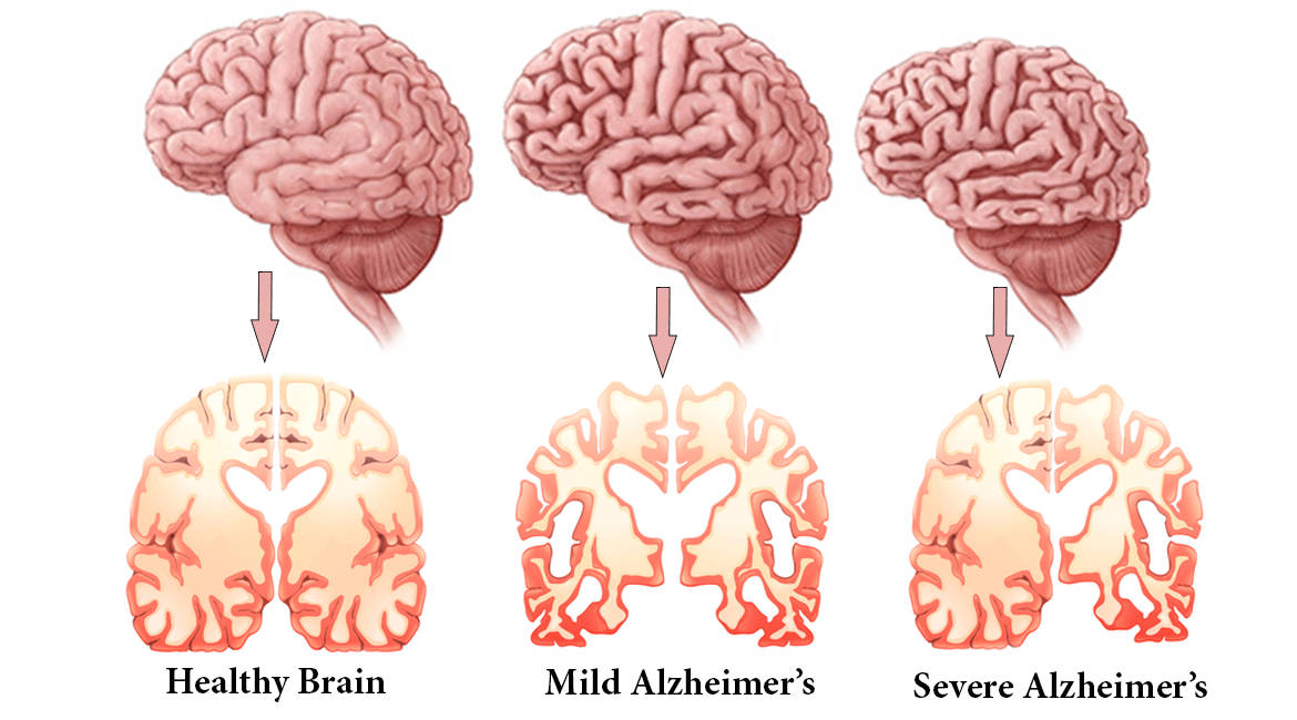 بیماری آلزایمر / Alzheimer