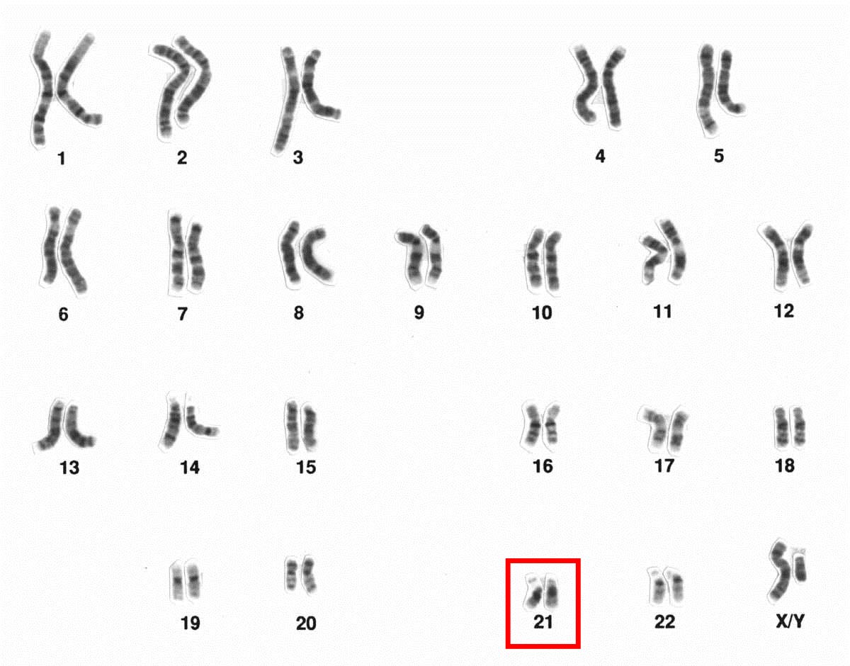 کروموزوم 21 / Chromosome