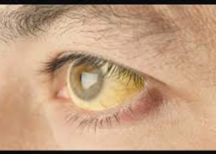 زردی چشم در اثر هپاتیت