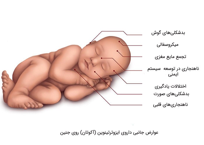 عوارض آکوتان روی جنین