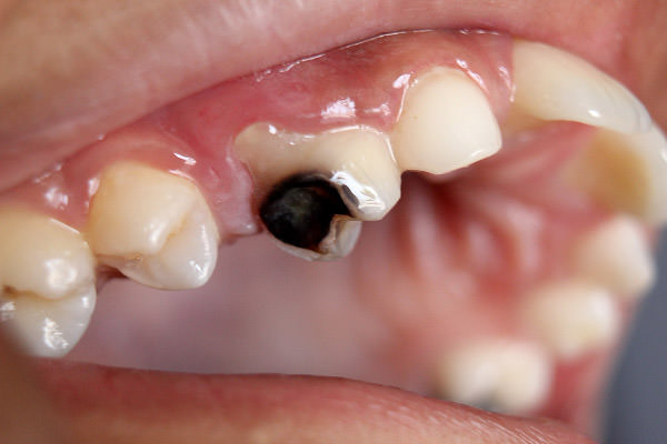 دندان پوسیده/ decay tooth
