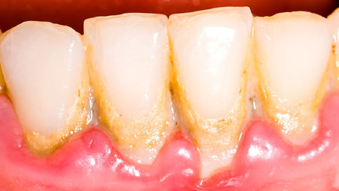 جرم دندان/ tooth plaque