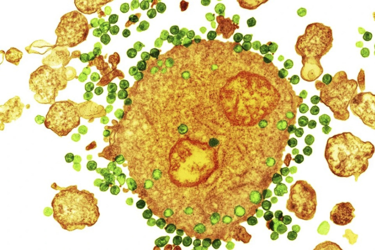 درمان عفونت بیمار ویروس HIV برای دومینبار
