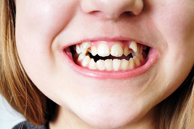 چرا دندانهای بیشتر افراد نامرتب است؟