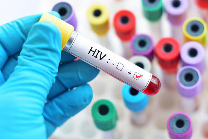 درمان HIV
