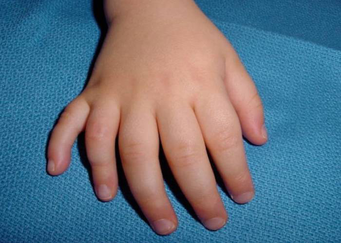 На 1 руке 6 пальцев. Полидактилия пальца стопы. Полидактилия генная мутация.