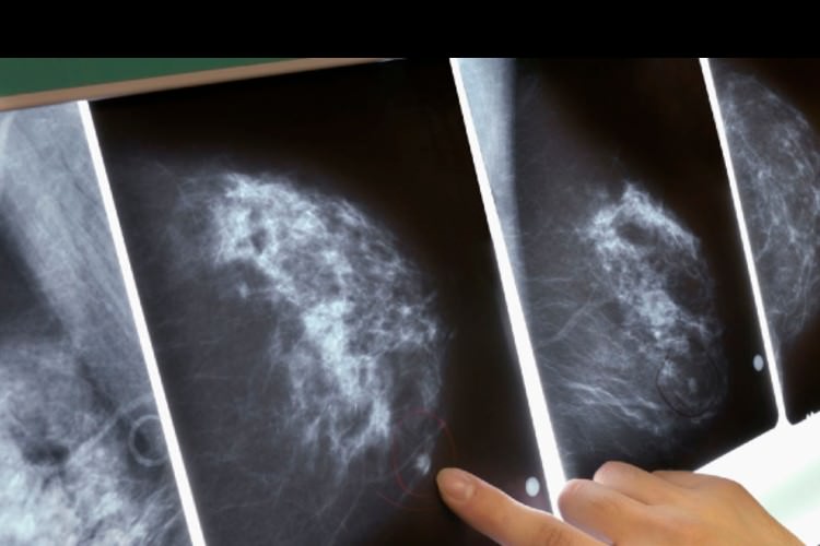 هوش مصنوعی موفق به تشخیص زودهنگام سرطان سینه شد 