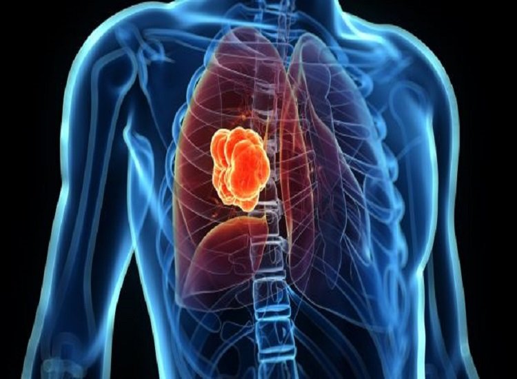 دانشمندان سرطان ریه را در افراد غیرسیگاری شناسایی کردند