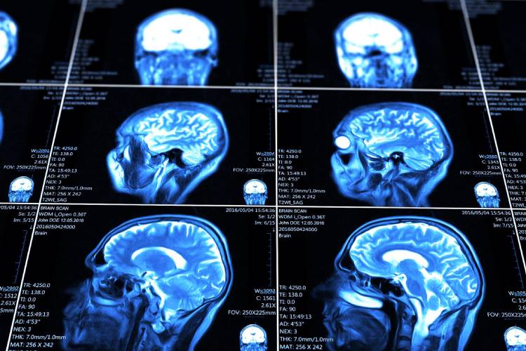 کشف نخستین نشانه‌های بیماری پارکینسون در مغز