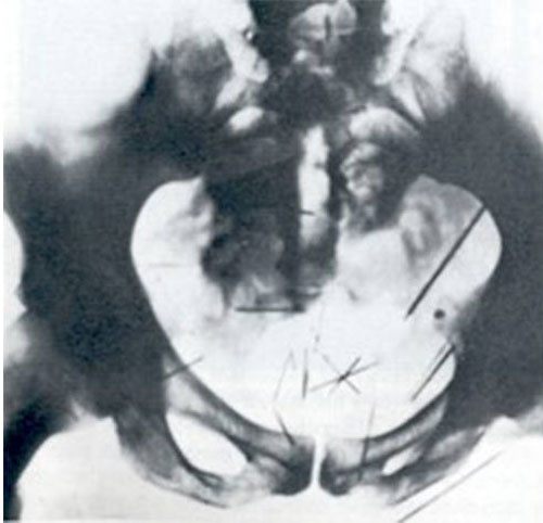 عکس رادیولوژی از لگن آلبرت فیش 