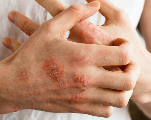 خارش پوست در اثر بیماری کلیه