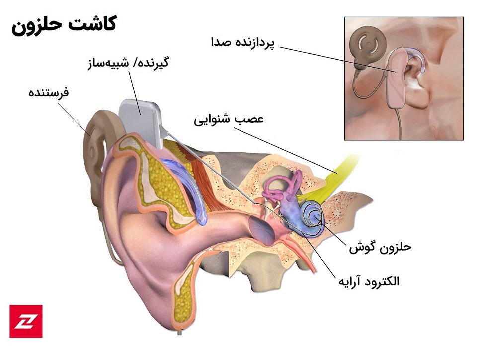 Cochlear implant / کاشت حلزون