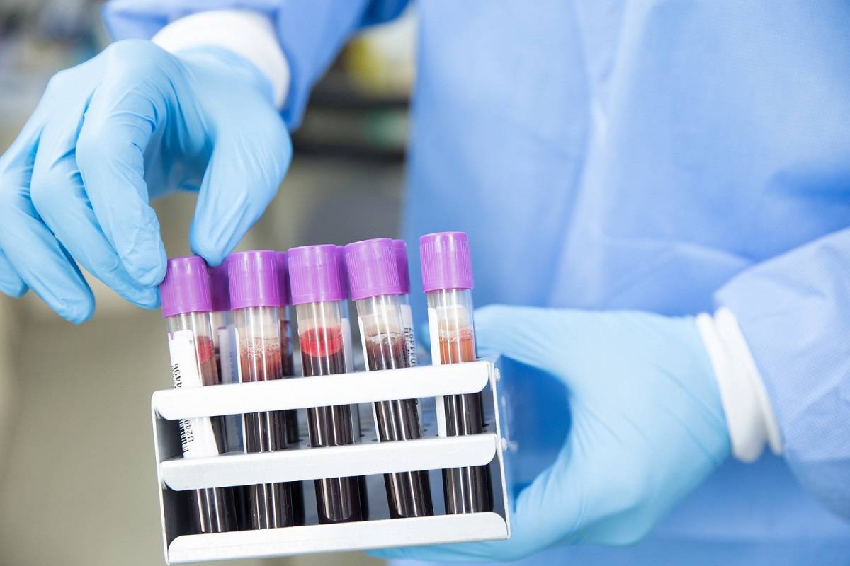 آزمایش تشخیص آنتی‌بادی ویروس کرونا در خون؛ کلید مبارزه با همه‌گیری جهانی
