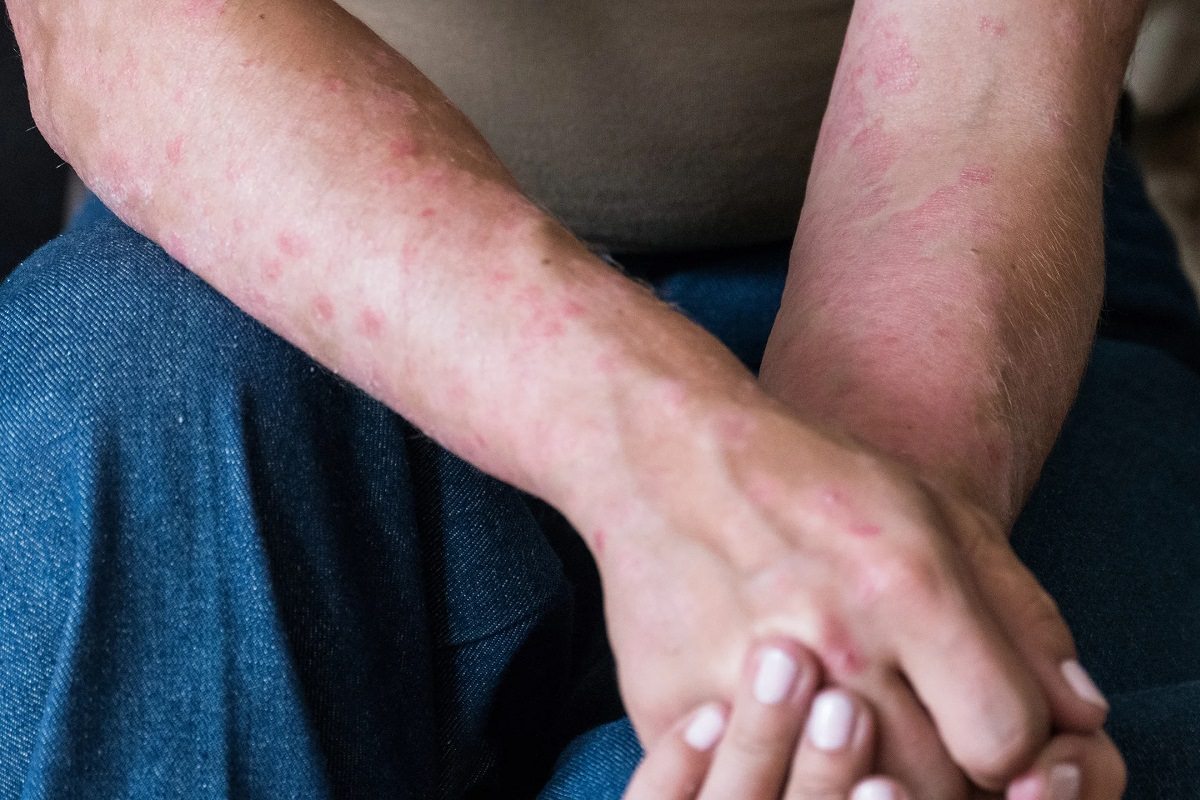 افزایش گزارش‌ها درباره بروز ضایعات پوستی در بیماران مبتلا به ویروس کرونا