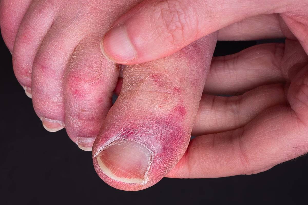 شاید بالاخره بدانیم علت انگشتان پای کوویدی چیست