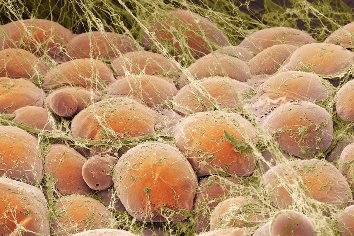 ویروس کرونا احتمالا به سلول‌های چربی حمله می‌کند