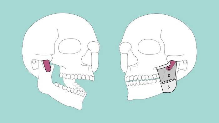 عضله ماستر / masseter muscle