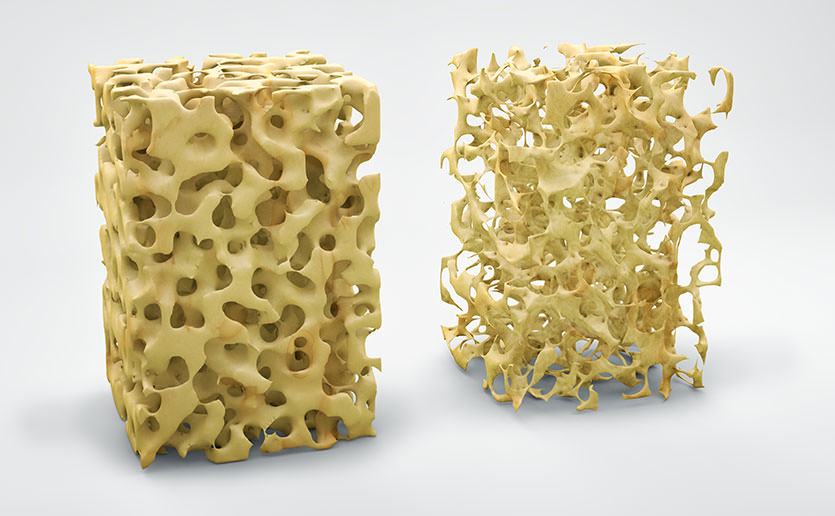 osteoporosis - نگاهی به ارتباط مصرف نوشابه و پوکی استخوان