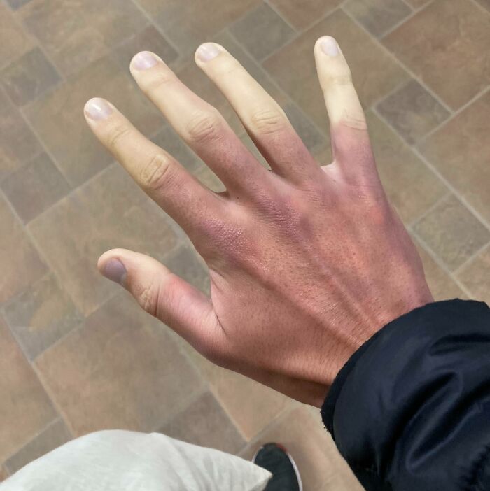 پدیده رینود - کاهش جریان خون در انگشتان