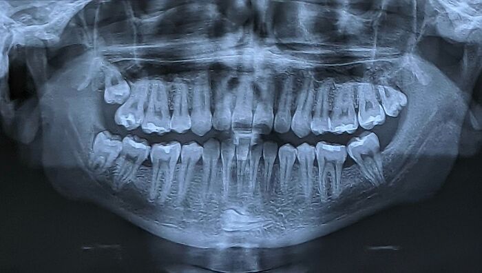 دندان در چانه