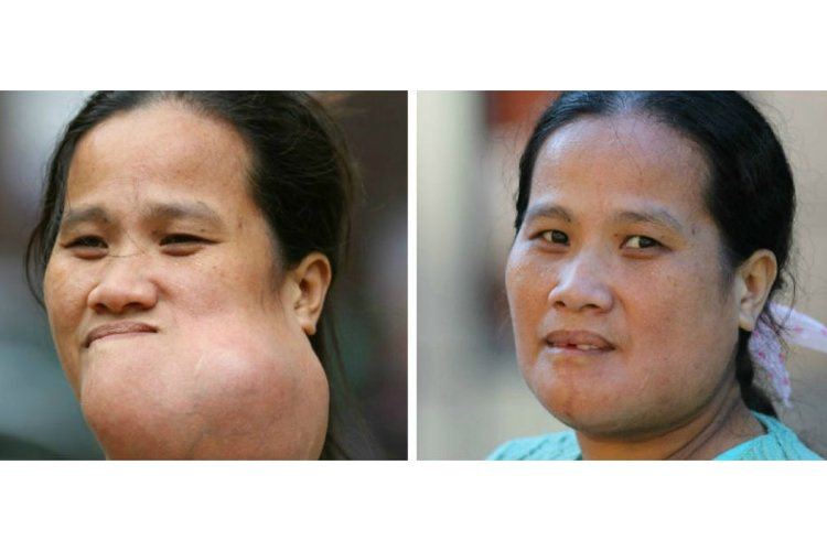 چگونه جراحان توانستند توموری عظیم را از صورت زن فیلیپینی بردارند