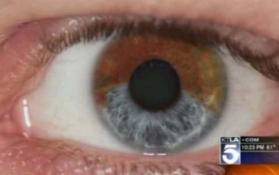 تغییر رنگ دائم چشمان شما با استفاده از لیزر در کمتر از 1 دقیقه  